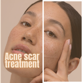 Acne Scars Treatment