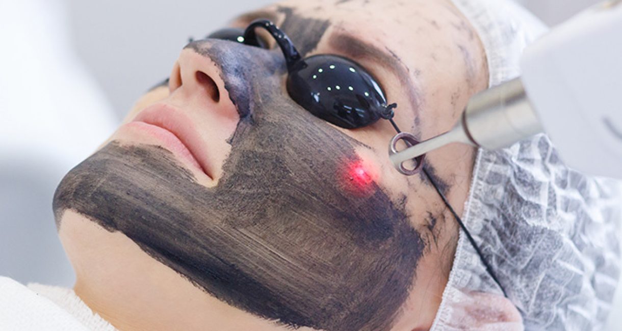 Carbon-laser-facial