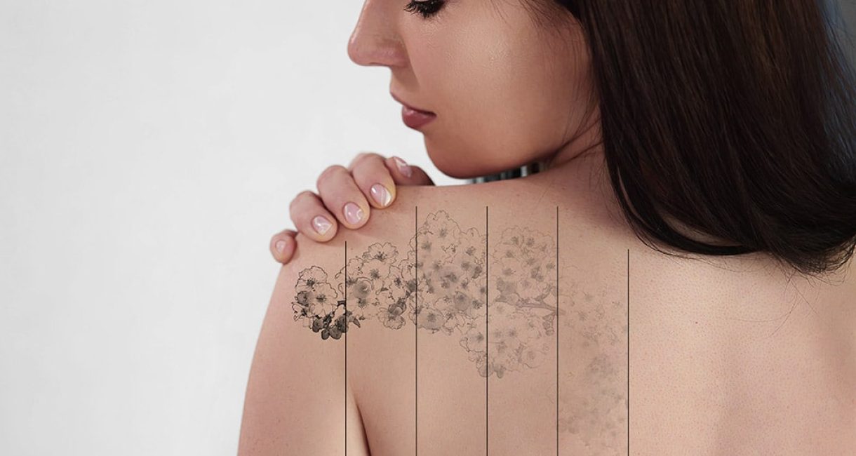 Laser Tattoo Removal On Woman's Shoulder. Medical Treatment