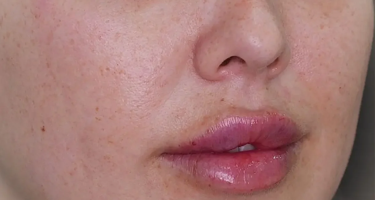 lipfiller_sharjah_bc89b24c44